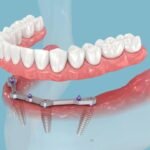 All-on-4 Dental Implants in Hungary