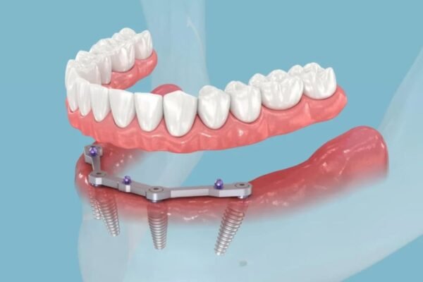 All-on-4 Dental Implants in Hungary