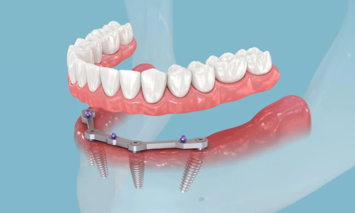 All-on-4 Dental Implants in Hungary